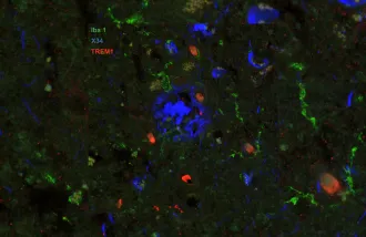 Image of post-mortem human frontal cortex showing TREM1 (red stain) in microglia and macrophages (Iba1; green stain) surrounding pathological amyloid buildup (X34; blue stain). The amount of TREM1 observed postmortem correlated with disease severity in Alzheimer’s patients.