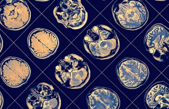 MRI images of brain scan