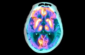 Superimposed scans show the brain of a person with Alzheimer’s disease. Image credit: Zephyr/Science Photo Library