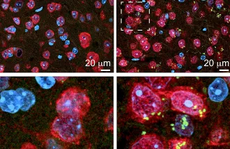 Four images with blobs of red, blue, and some green representing accumulating proteins in brain cells.