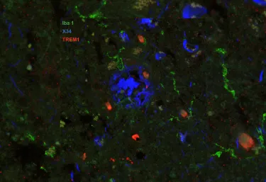 Image of post-mortem human frontal cortex showing TREM1 (red stain) in microglia and macrophages (Iba1; green stain) surrounding pathological amyloid buildup (X34; blue stain). The amount of TREM1 observed postmortem correlated with disease severity in Alzheimer’s patients.