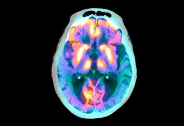 Superimposed scans show the brain of a person with Alzheimer’s disease. Image credit: Zephyr/Science Photo Library