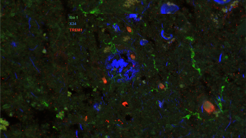 Image of post-mortem human frontal cortex showing TREM1 (red stain) in microglia and macrophages (Iba1; green stain) surrounding pathological amyloid buildup (X34; blue stain). The amount of TREM1 observed postmortem correlated with disease severity in Alzheimer’s patients.